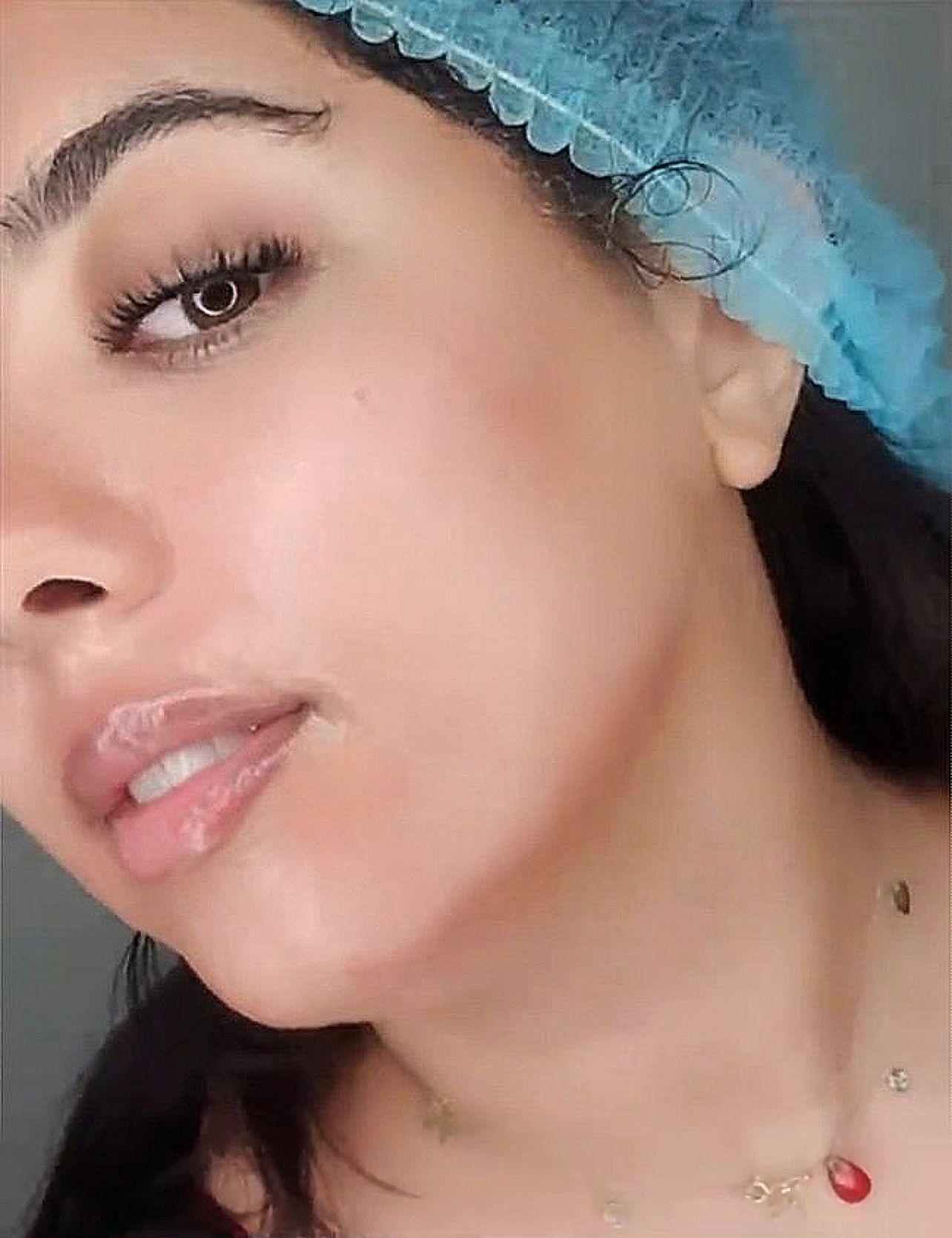 Micro-Needling à Marrakech